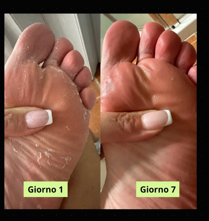 Mirenna® Sapone Purificante Antimicotico