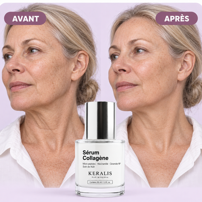 Avant après KERALIS, cou et ovale du visage